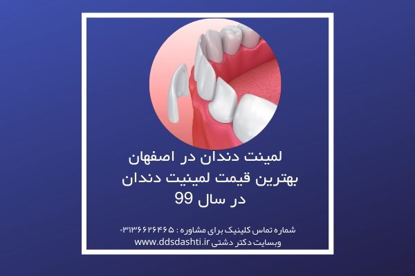 لمینت دندان در اصفهان | بهترین قیمت لمینیت دندان در سال 99
